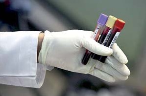 امکان تشخیص زودرس HIV در کشور فراهم شد