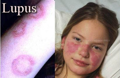 بیماری لوپوس را می شناسید؟