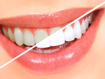 سفید کردن دندان در خانه به جای لمینت