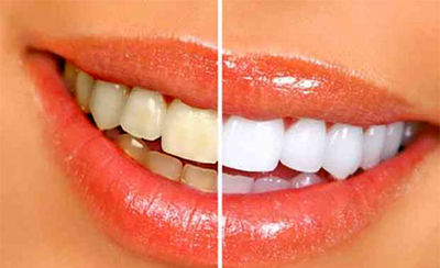 زرد شدن دندان را جدی بگیرید/ نقش عوامل داخلی در تغییر رنگ دندان