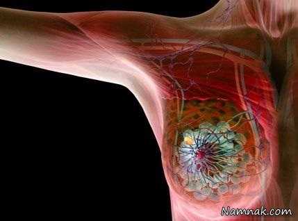 تشخیص زودهنگام سرطان پستان رهایی از مرگ