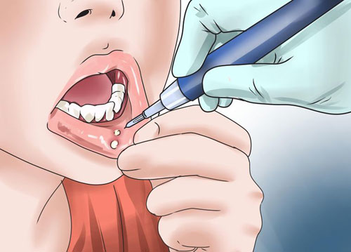 زخم‌های دهانی عارضه اصلی ابتلا به سرطان‌های سر و گردن