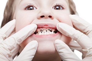 شیوع بالای پوسیدگی دندان در ایران/ ۹۰ درصد کودکان ۶ ساله دچار پوسیدگی دندان هستند
