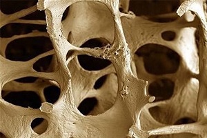 قطعی‏‌ترین روش برای تشخیص پوکی استخوان