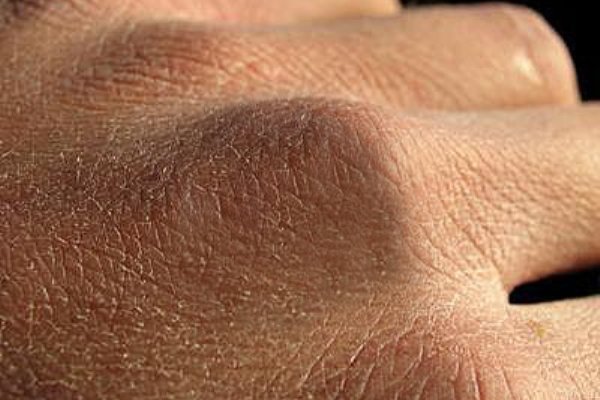 راه های پیشگیری از خشکی پوست را بشناسید