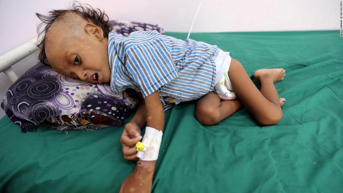 85000 کودک زیر 5 سال در جنگ یمن از گرسنگی جان باخته اند
