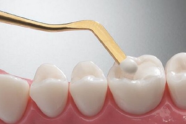 تولید نانوکامپوزیت‌های دندان نژاد ایرانی در کشور/ جلوگیری از خروج ۸ میلیون دلار ارز
