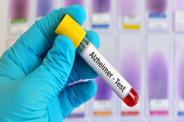 نتایج امیدبخش نوعی آزمایش خون در تشخیص بیماری آلزایمر