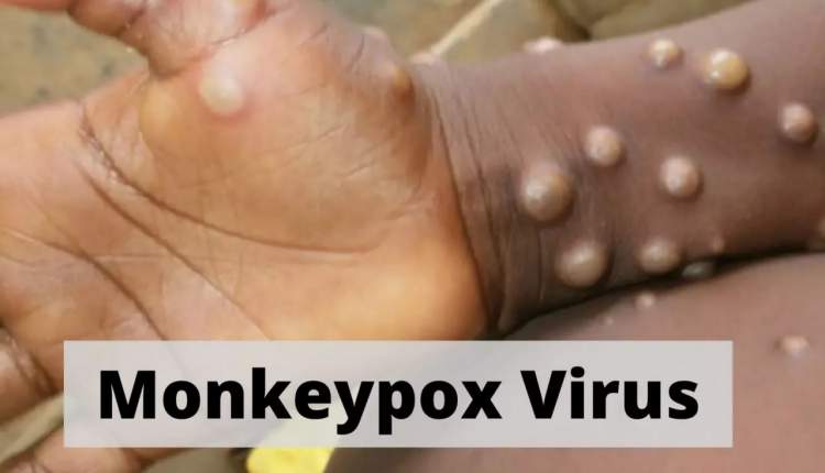 کشندگی آبله میمونی نادر است/ واکسیناسیون می تواند جلوی ابتلا را بگیرد/ شدت سرایت به اندازه اومیکرون نیست