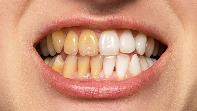 دهان شویه و دخانیات رنگ دندان را تغییر می دهند/ عارضه مصرف تتراسایکلین در بارداری