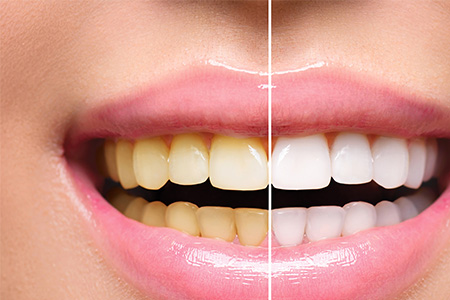 آیا کامپوزیت دندان قابل برداشتن است و چگونه این کار انجام می شود؟////تکمیل شد